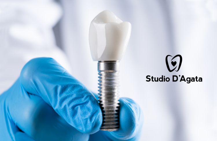 Un close-up di un impianto dentale