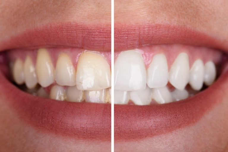Close-up di un prima e dopo di uno sbiancamento dentale